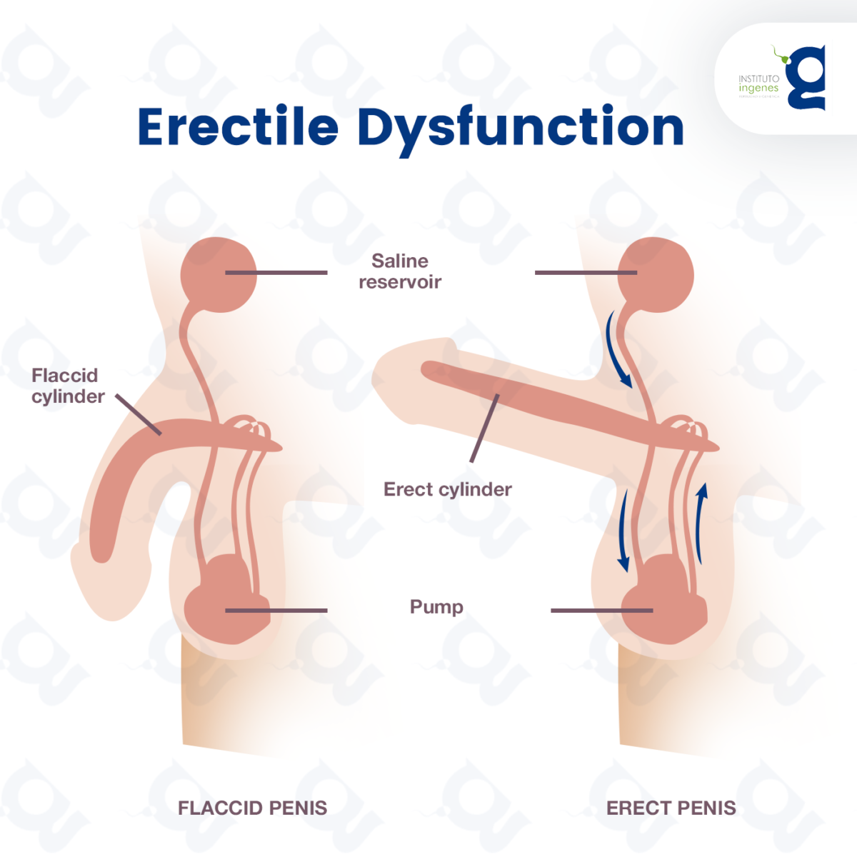 How is Erectile Dysfunction (ED) Diagnosed?
