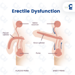 How Are Depression and Erectile Dysfunction related?